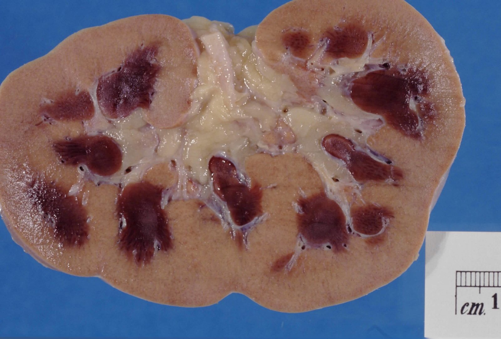 Acute Kidney Injury Management
