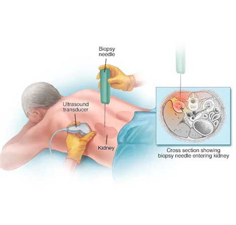 Glomerular Disease and Renal Biopsy